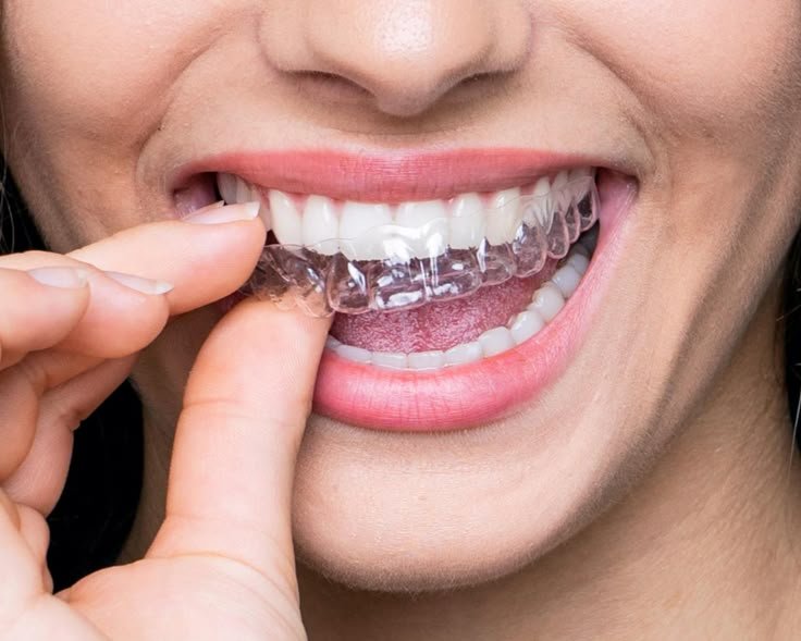 Invisalign